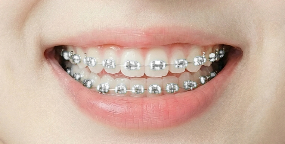 Teeth with braces